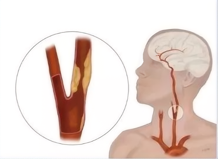 超千万中国人体检结果：两成有颈动脉斑块
